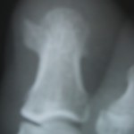 Osteocondroma