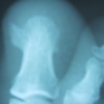 Osteocondroma