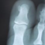 Osteocondroma